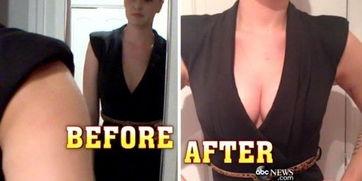 注射盐水隆胸视频,视频揭示手术全过程与风险