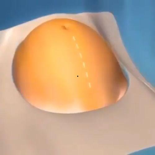 刨腹产视频播放,真实视频带你直观体验